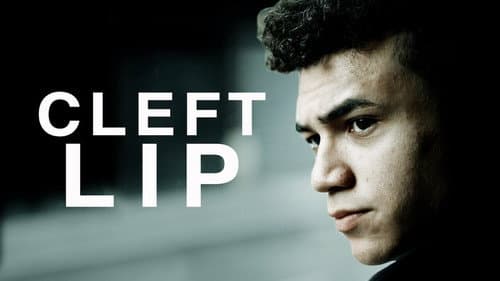 Cleft Lip still